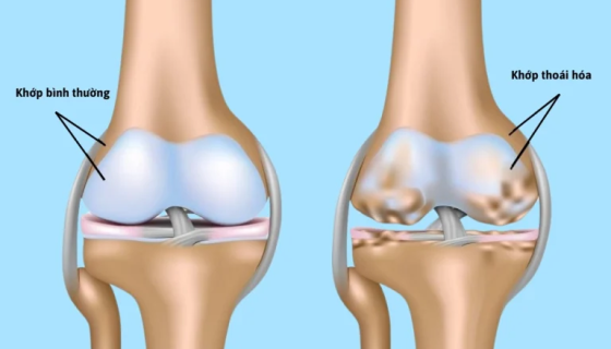 Sự khác nhau giữa thoái hóa khớp và viêm khớp dạng thấp – hiểu đúng để điều trị hiệu quả
