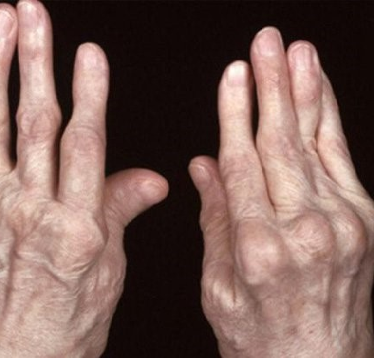Viêm khớp dạng thấp là gì? Dấu hiệu nhận biết & phương pháp điều trị an toàn